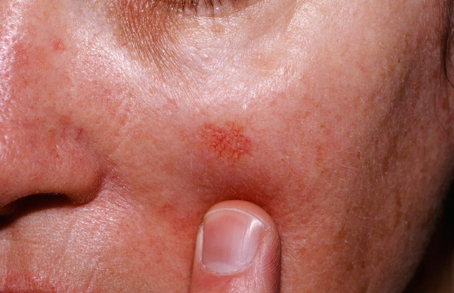 queratosis actinica