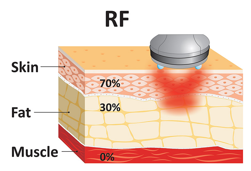 radiofrequency or microwaves patent Onda Coolwaves