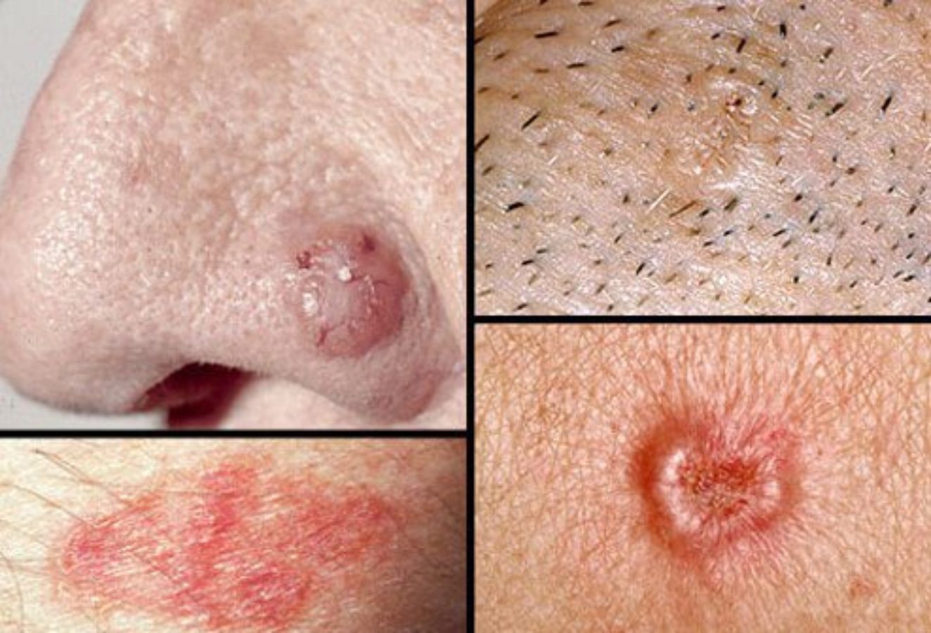 skin cancer s19 basal cell carcinoma