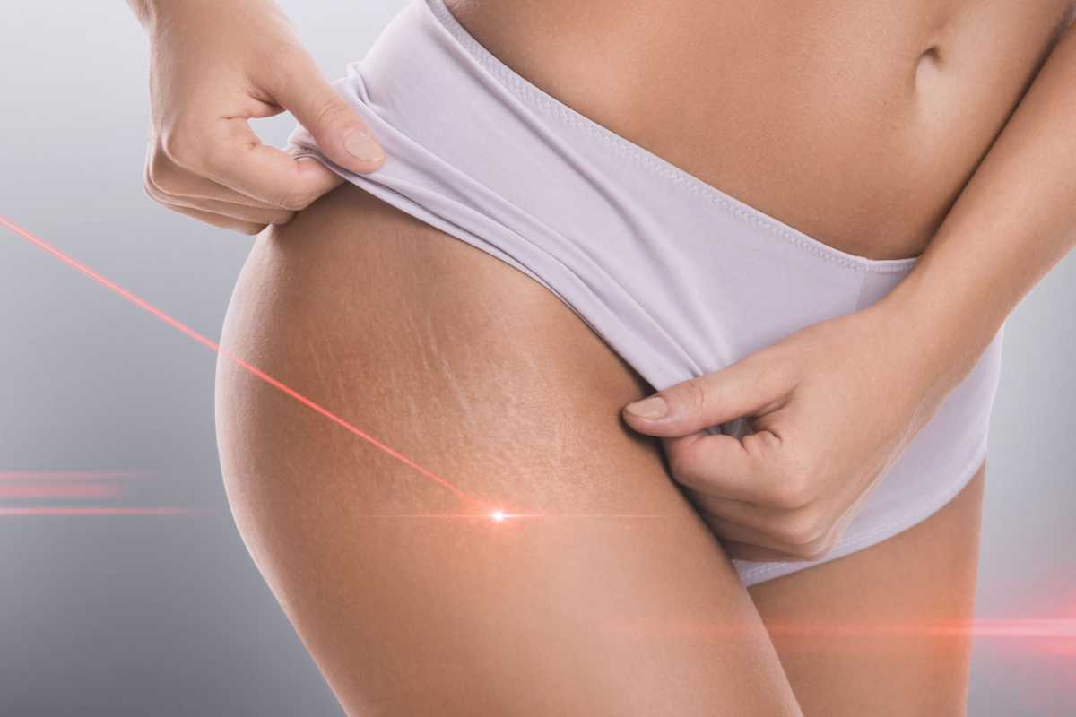 Fractional laser CO2